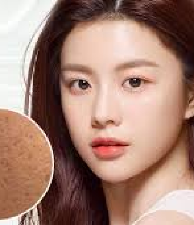 Điều Trị Sẹo Rỗ